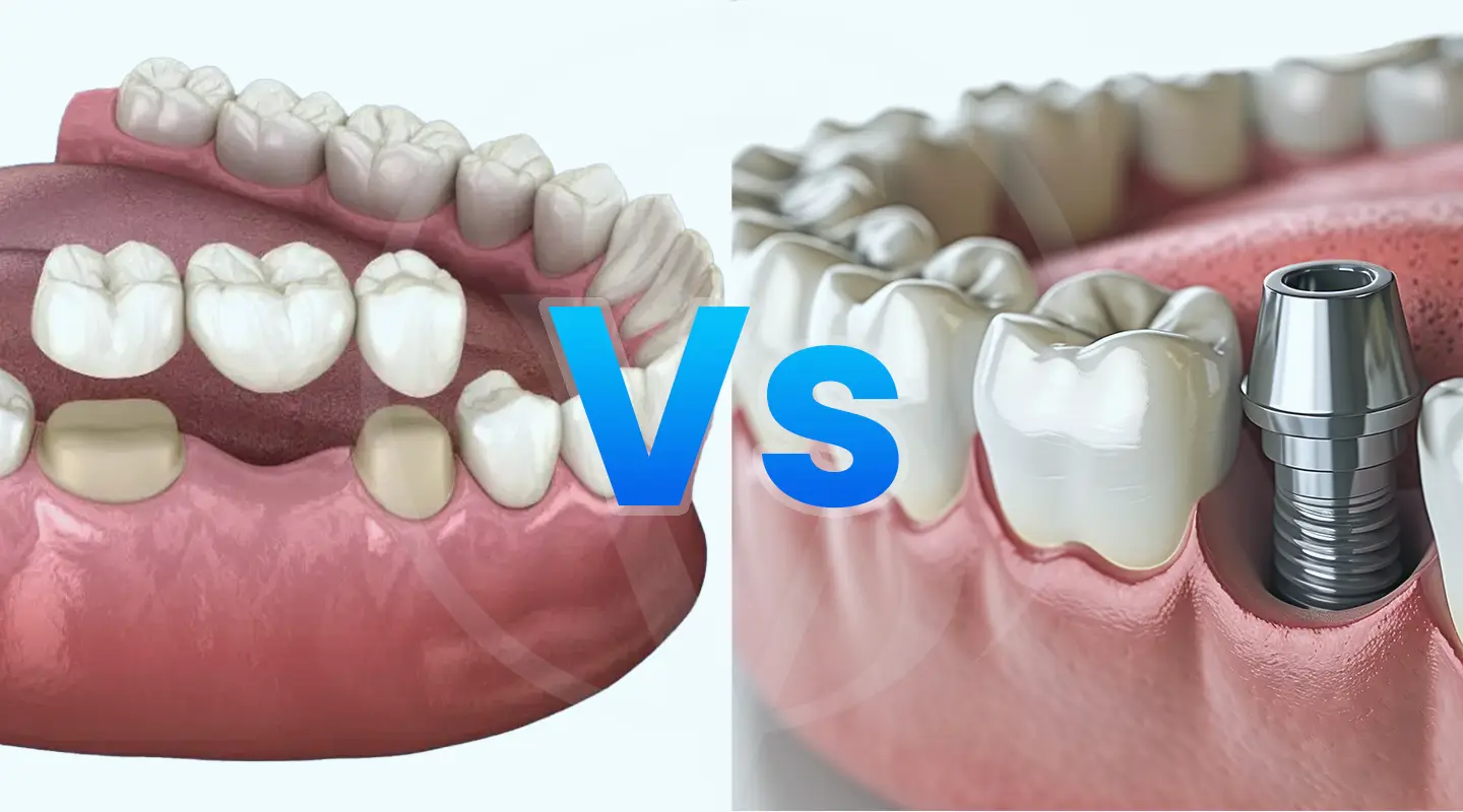 Puentes Dentales Vs Implantes Dentales Cu L Es Mejor