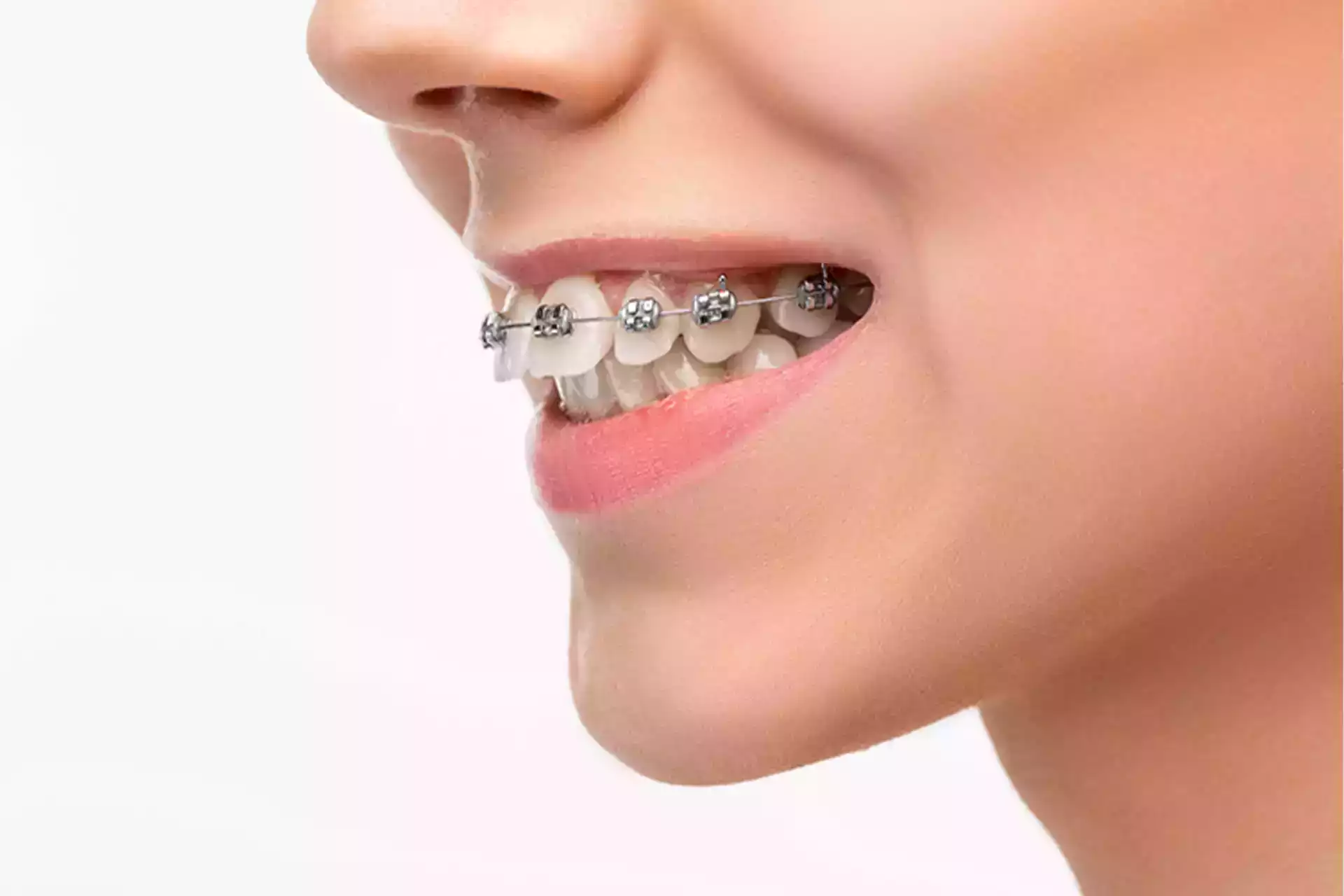 https://www.verasmile.com/wp-content/uploads/2021/05/Fixing-an-Overbite-with-Crowns-Does-It-Work-min-min-min.webp
