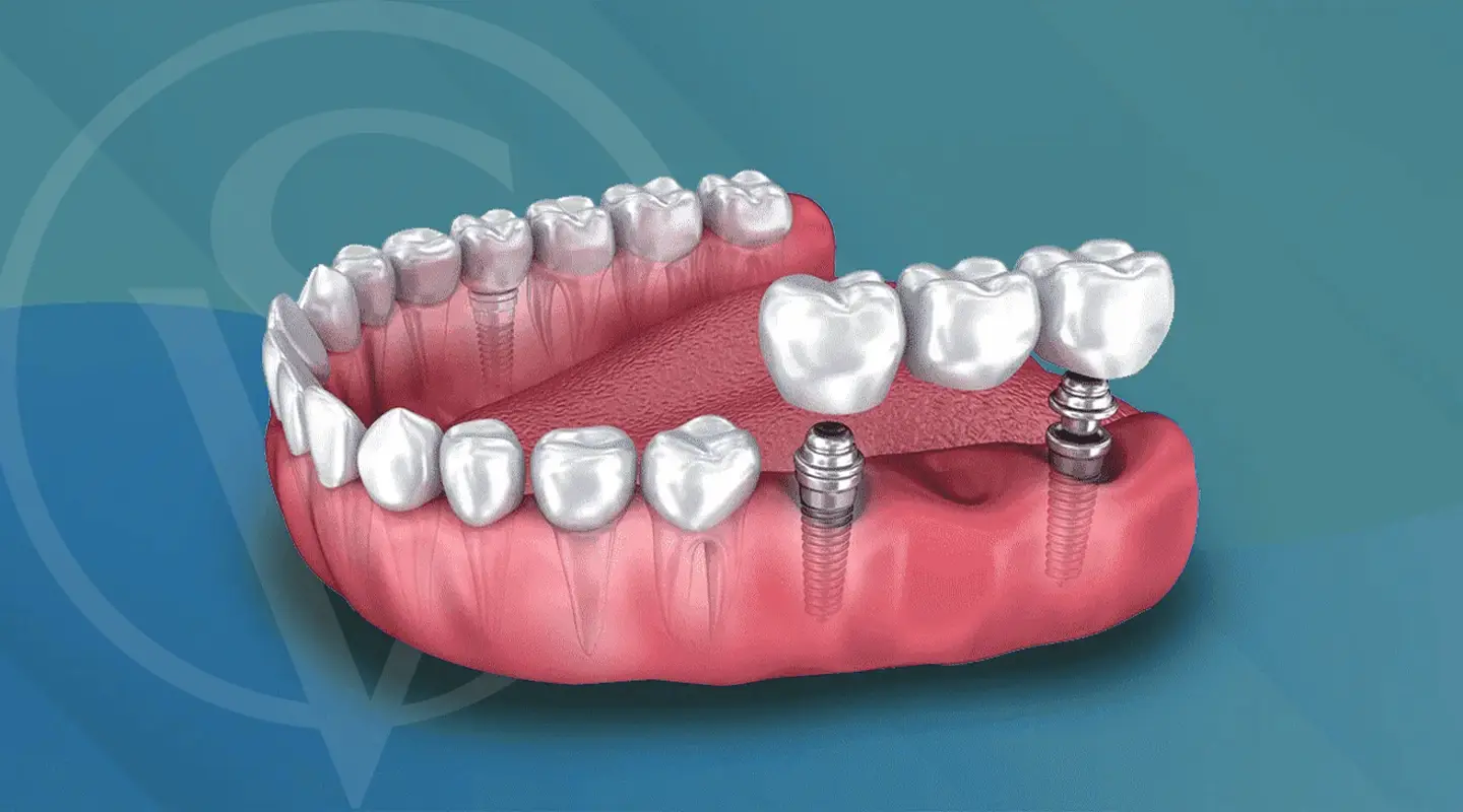 Puentes Dentales al Descubierto: Lo Que Necesitas Saber Antes de Decir Sí