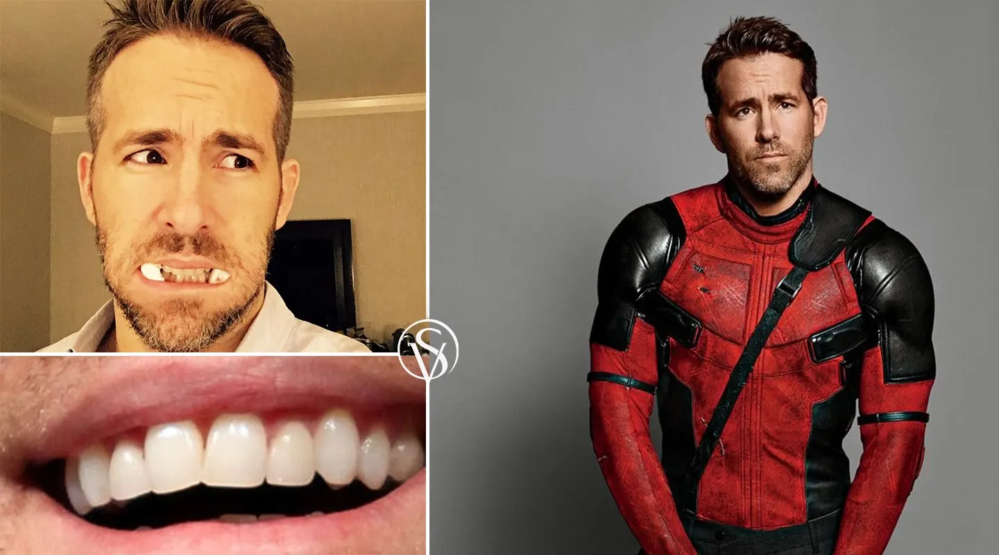 Is Ryan Reynolds' Teeth the result of Veneers or Just Superhero Swagger ...